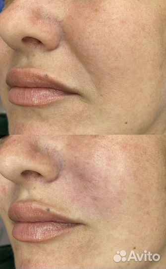 Биоревитализация