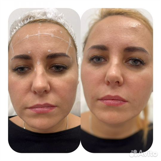 Обучение инъекционной косметологии