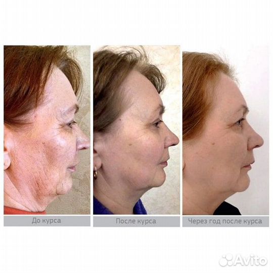 Аппарат Lutronic infini Для рф-Лифтинга