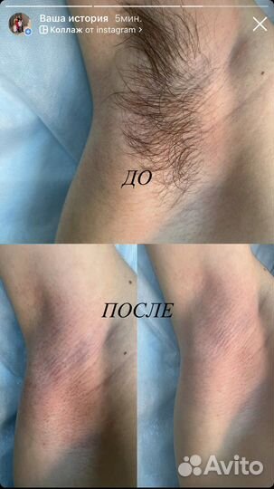 Шугаринг женский