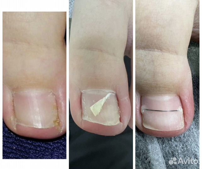 Подолог, педикюр