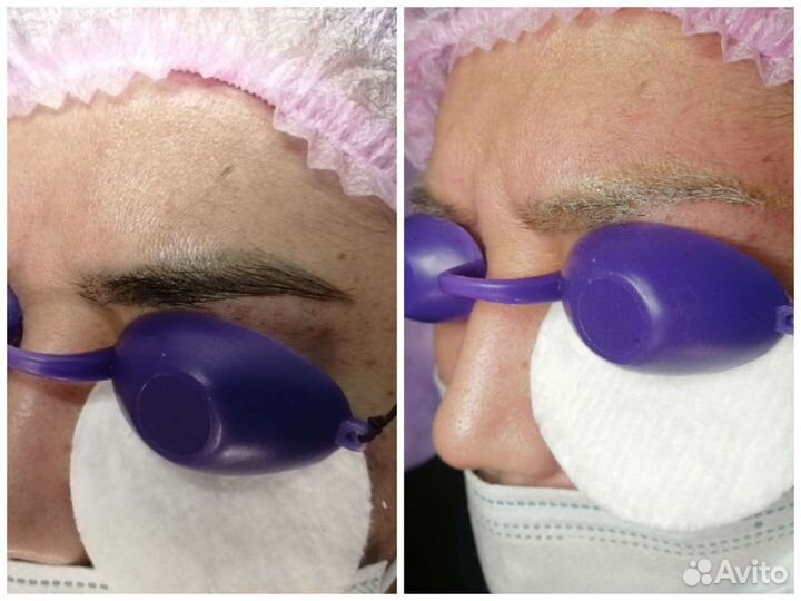 Удаление татуажа лазером/ эпиляция