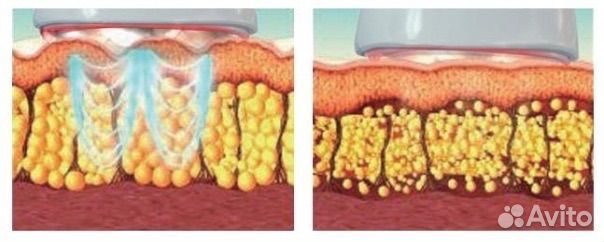Ультразвуковая кавитация, РФ лифтинг тела