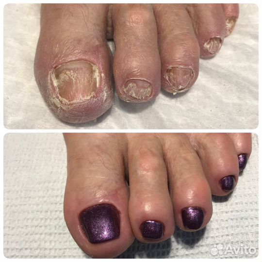 Лечебный педикюр Подолог