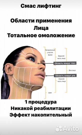 SMAS лифтинг лица