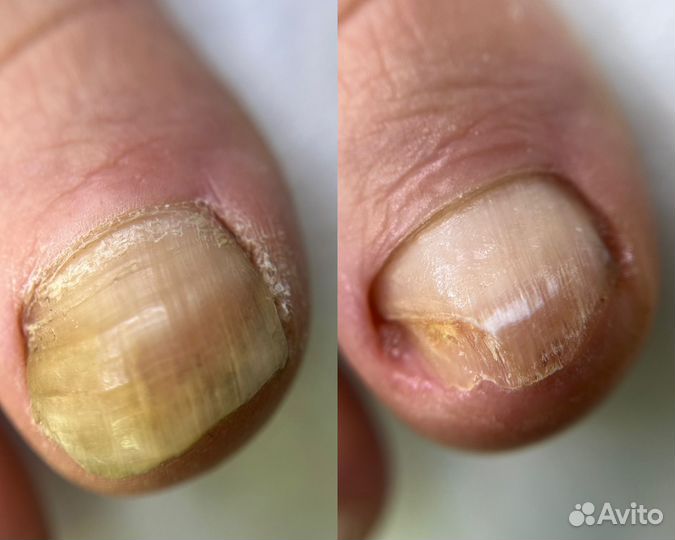 Медицинский педикюр