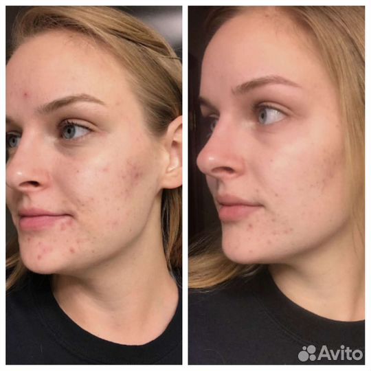 Лазерное лечение акне