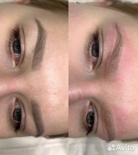 Удаление татуажа