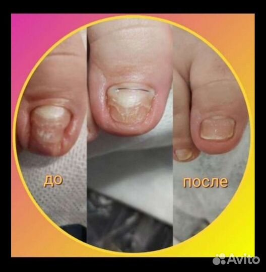 Вросший ноготь