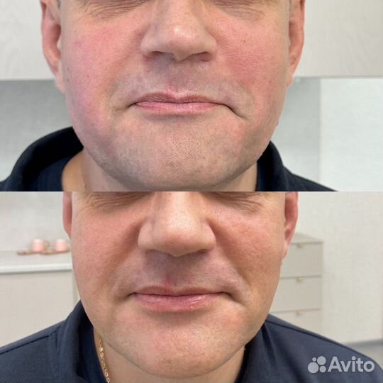 SMAS лифтинг Крио hifu + vmax HS-A55