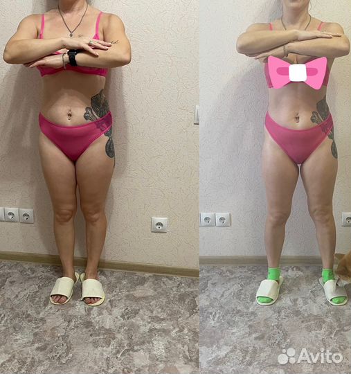 Антицеллюлитный массаж, кавитация, RF, массаж ШВЗ