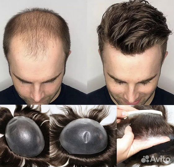 Мужская система замещения волос