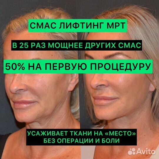 СМАС- лифтинг лица и тела ультраформер MPT