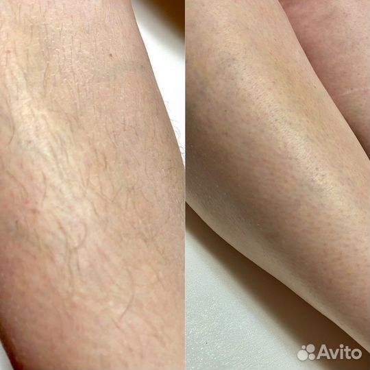 Шугаринг/Ваксинг