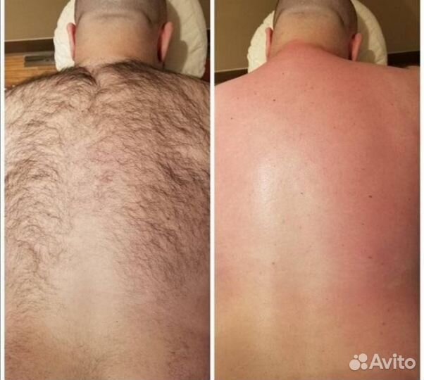 Депиляция для мужчин