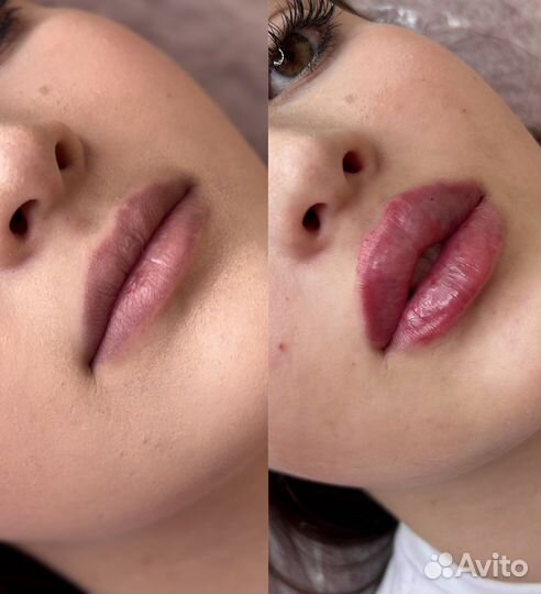 Косметолог,липоредукция, губы,углы,ботокс,ягодицы