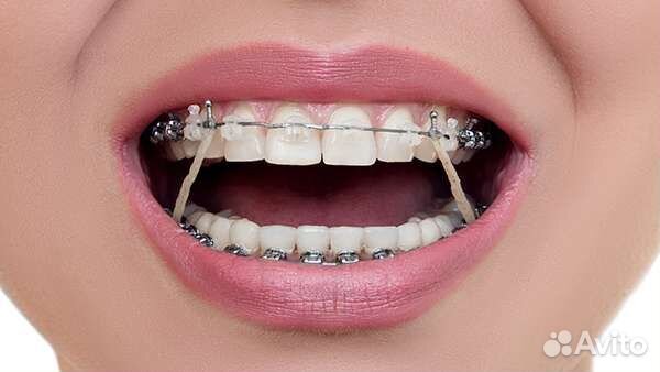 Ортодонтические резинки для брекетов/тяги