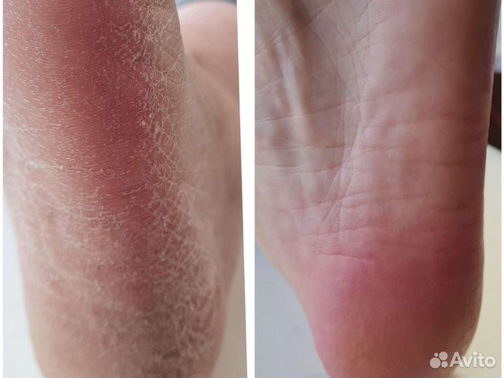 Вросший ноготь проблемная стопа, маникюр