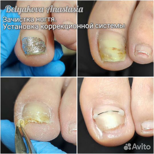 Подолог. Работа со сложными стопами