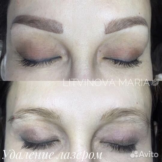 Удаление татуажа