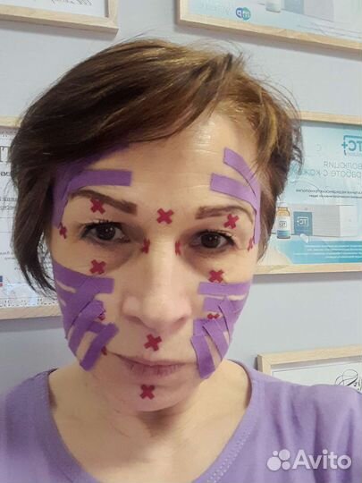 Эстетическое тейпирование