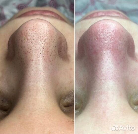 Массаж лица