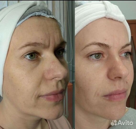 LPG массаж на оригинальном Французском аппарате