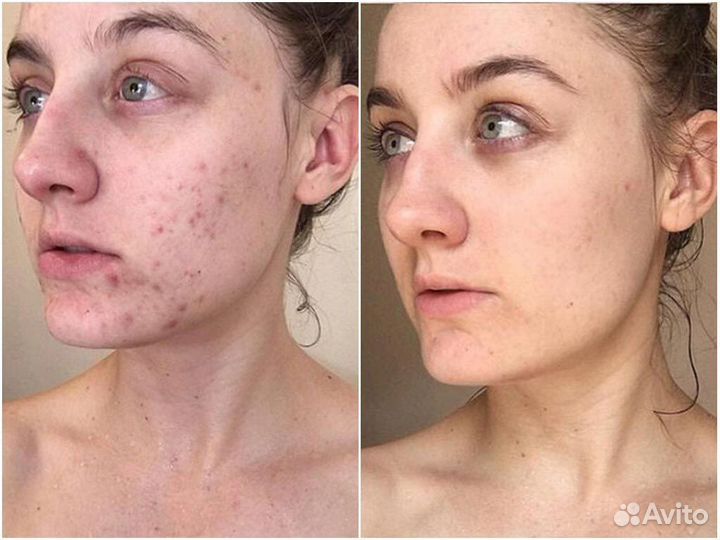 Комплексное лечения Акне /Дерматолог