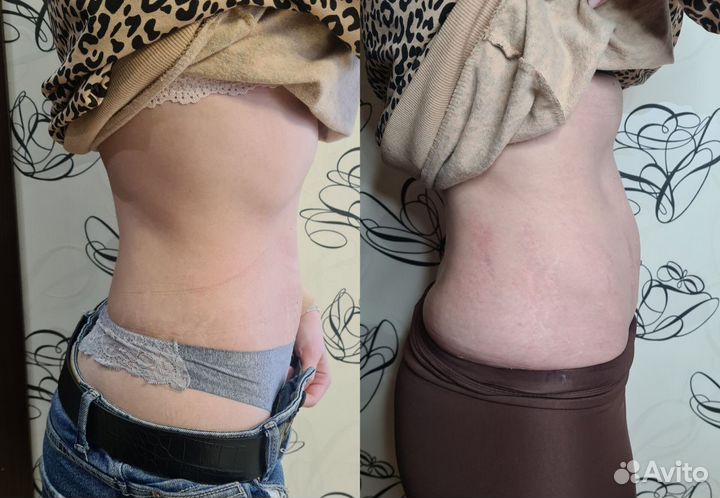 СМАС лифтинг лица