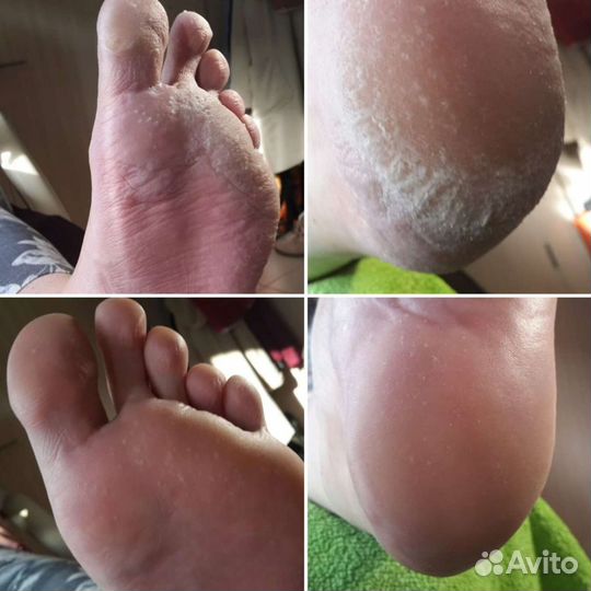 Гидромассаж. Подводный душ массаж