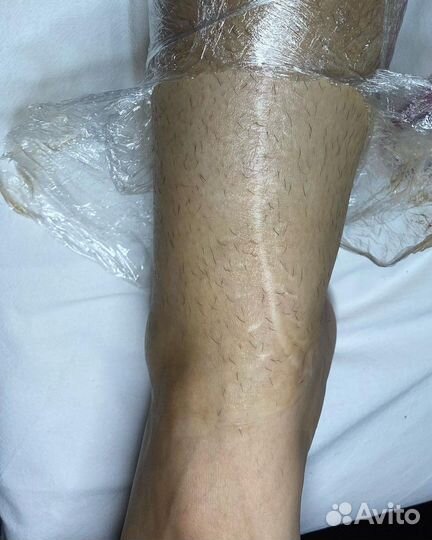 Электроэпиляция