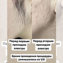 Электроэпиляция, Шугаринг, оформление бровей, Энгельс