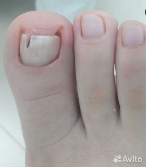 Медицинский педикюр подолог
