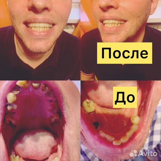 Протезирование и ремонт зубных протез