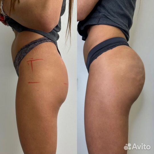 Увелечение ягодиц