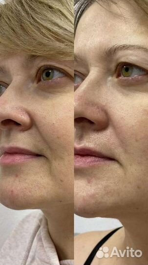 Массаж лица и зоны декольте