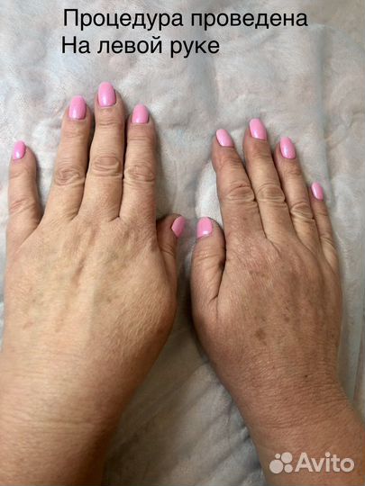 Элос эпиляция