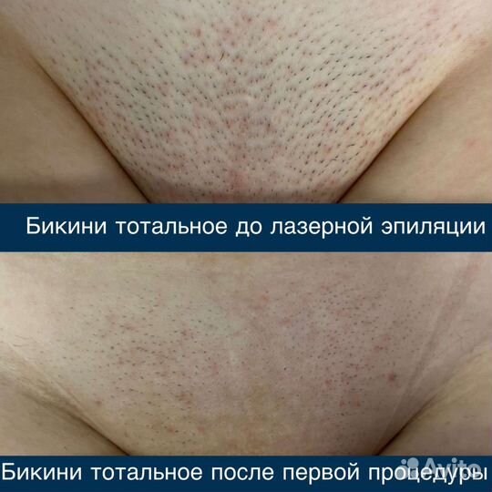 Лазерная эпиляция на диодном лазере