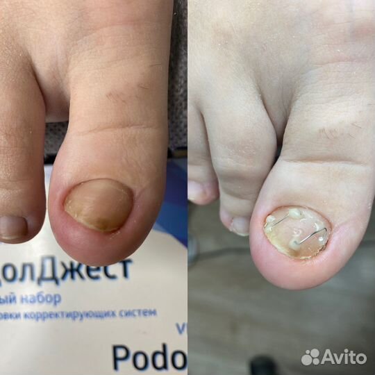 Подолог. Вросшие ногти, трещины, мозоли