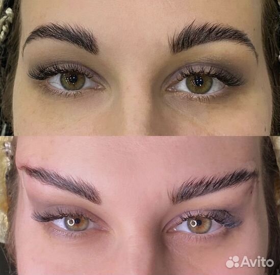 Инъекции ботокса в подмышки