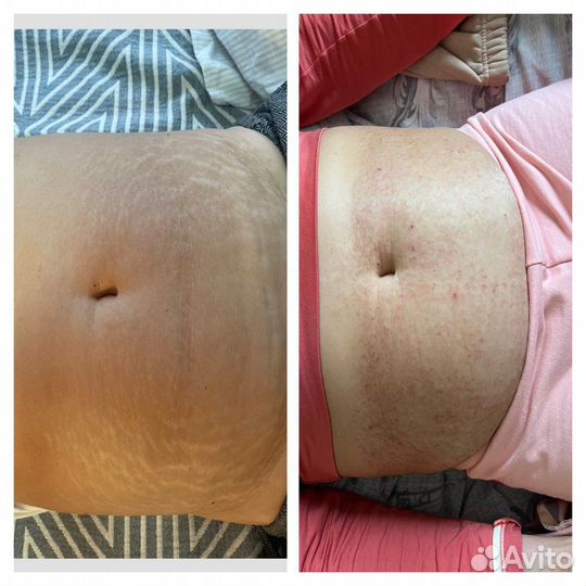 Процедура холодной плазмы/Омоложение