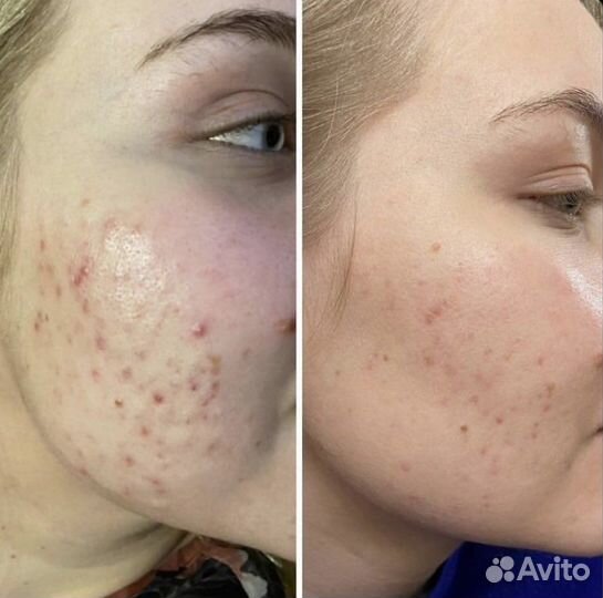 Комплексная Чистка Лица и Биоревитализация