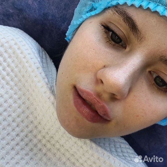 Увеличение губ