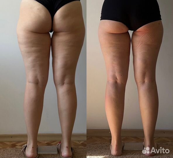 LPG (5 сеансов вакуумного массажа для позулкния)