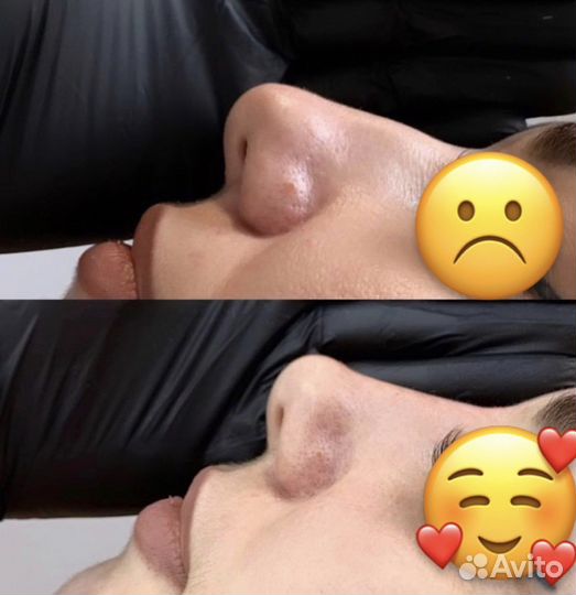 Коррекция формы носа, ринопластика без операции