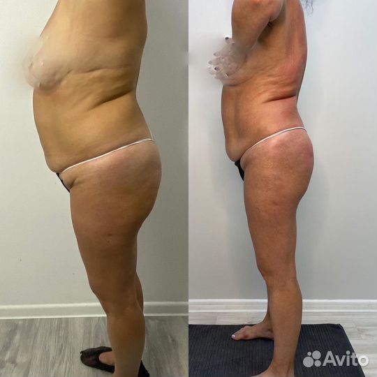 Антицеллюлитный/лимфодренажный массаж