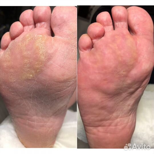 Лечебный маникюр,педикюр,грибок,трещины,грибок