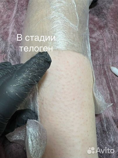 Электроэпиляция