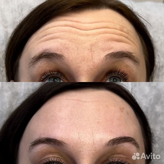 Модель на ботокс лица