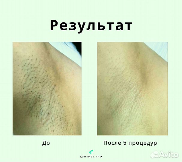 Диодный лазер для эпиляции люминес MaxOne 1200